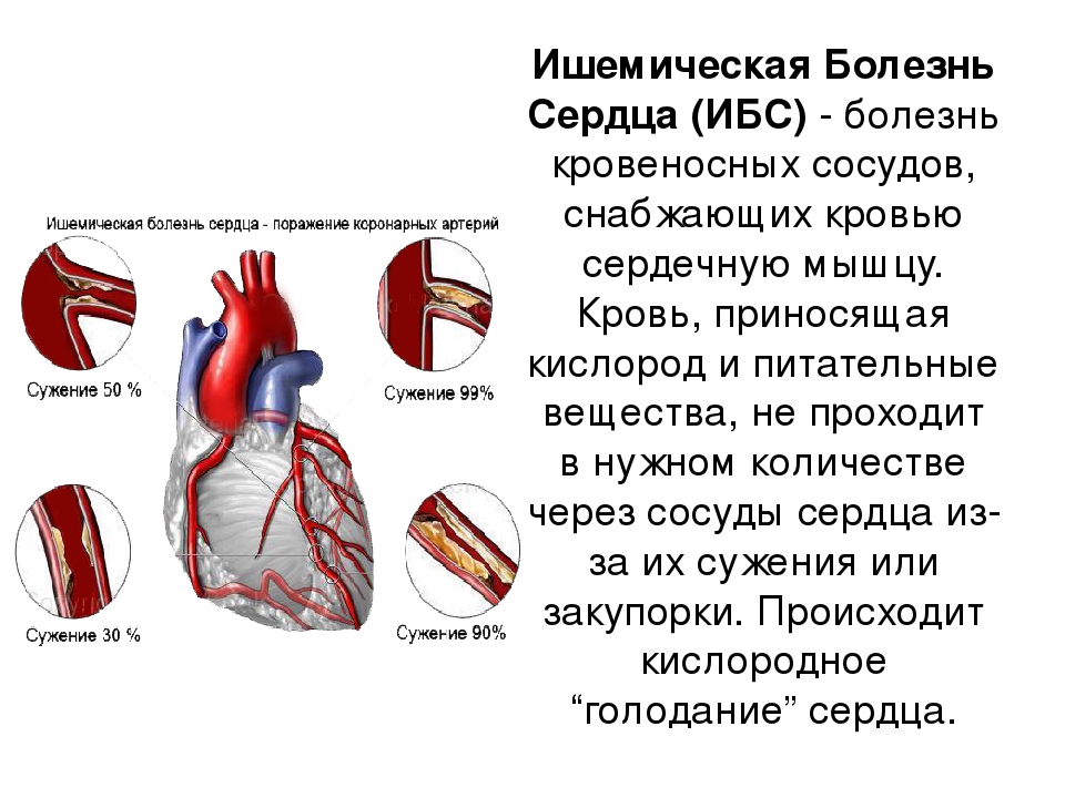 Ибс стенокардия презентация