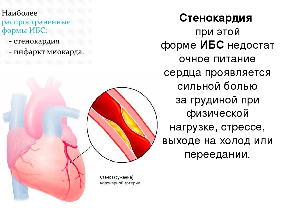Сколько живут с ишемией. Ишемическая болезнь сердца симптомы профилактика. ИБС стенокардия инфаркт миокарда. Стенокардия при ишемической болезни. Клинические проявления ишемической болезни сердца.