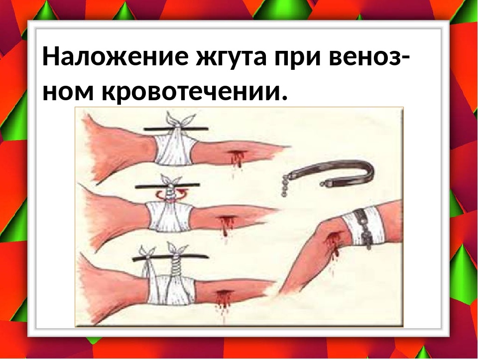 При обильном венозном кровотечении жгут накладывается. Наложение жгута при венозном кровотечении. При венозном кровотечении жгут накладывается. Венозное кровотечение наложение жгута. При венозном кровотечении.