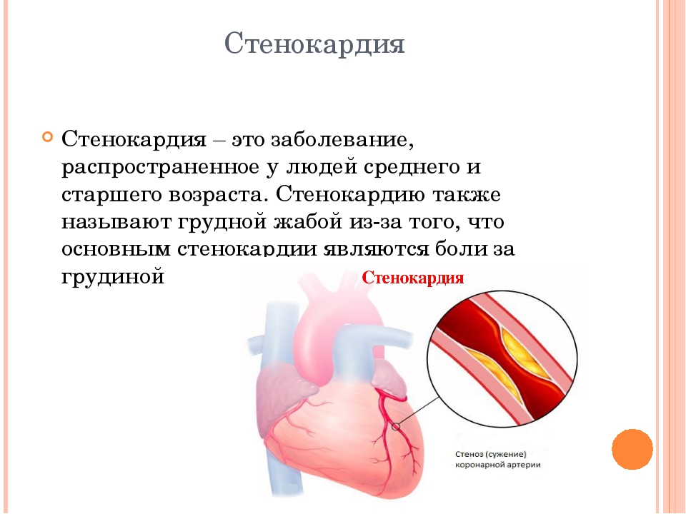 Сердечная недостаточность у мужчин. Стенокардия это заболевание. Стенокардия и сердечная недостаточность. Сердечная недостаточностьстенокордия. Стенокардия Возраст.