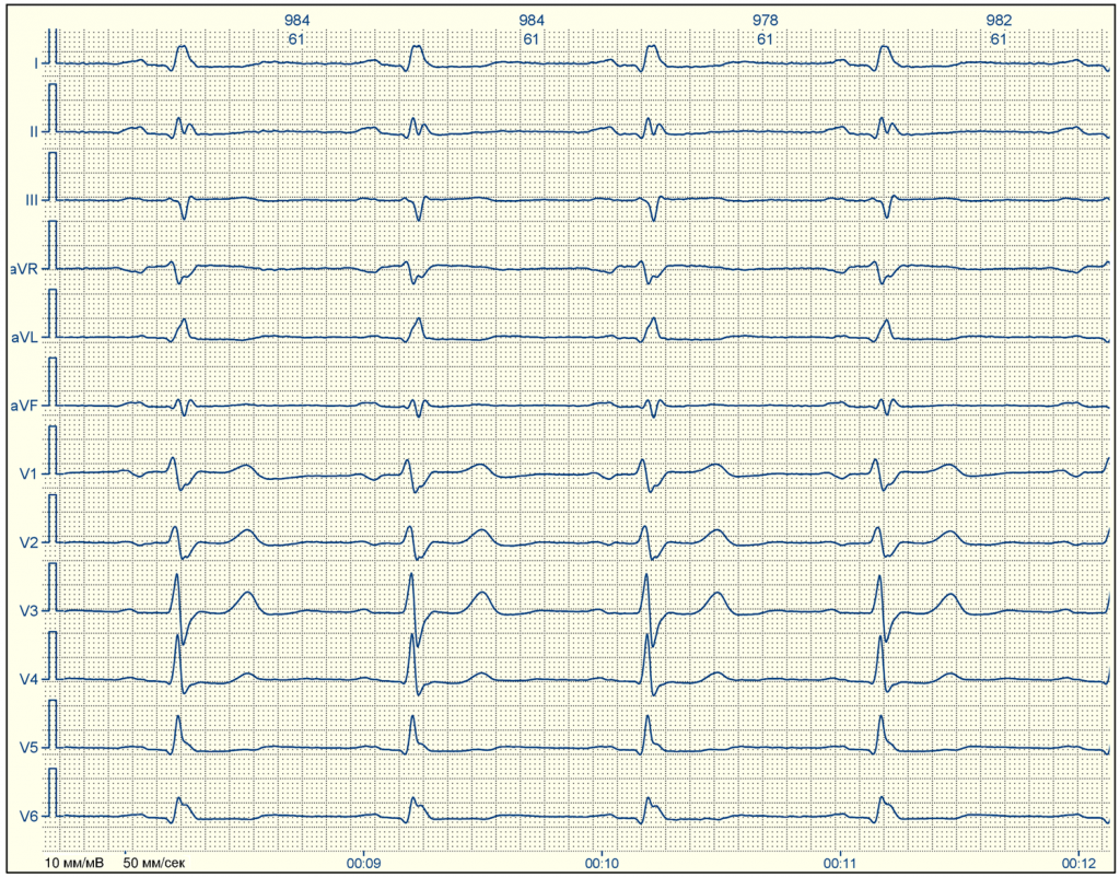 Пример ЭКГ с расшифровкой для чайников 