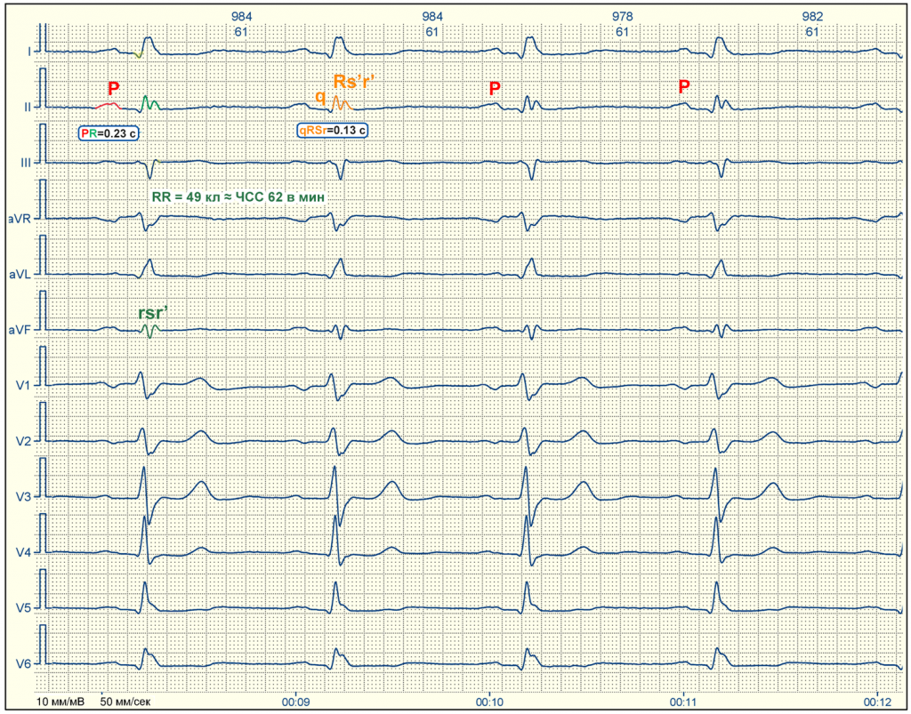 Пример ЭКГ с расшифровкой для чайников 