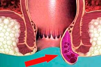 Виды геморроя с кровью