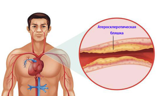 Доказано: отказ от животного белка лечит атеросклероз