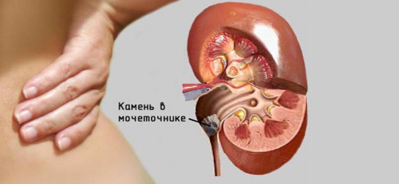 Как определить что болит: поясница или почки