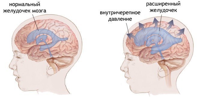 Повышенное внутричерепное давление: ЧТО делать