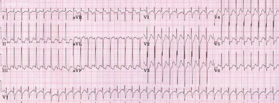 Пароксизмальная наджелудочковая тахикардия. Пароксизмальная тахикардия ЭКГ. Суправентрикулярная тахикардия (свт) ЭКГ. Наджелудочковая тахикардия на ЭКГ. Наджелудочковая тахиаритмия ЭКГ.