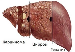 Узи печени с контрастным веществом