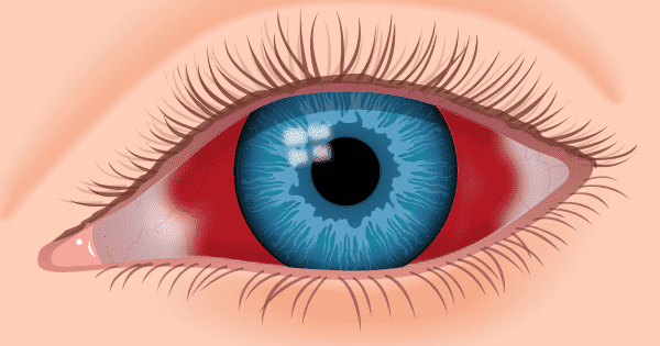 Капли глазные при кровоизлиянии в глазу – что капать, какие капли