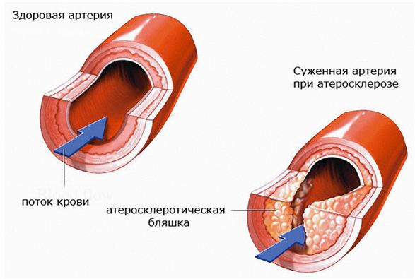 Патологии в стволе