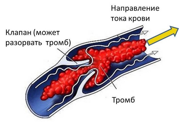 возникновение тромбоза