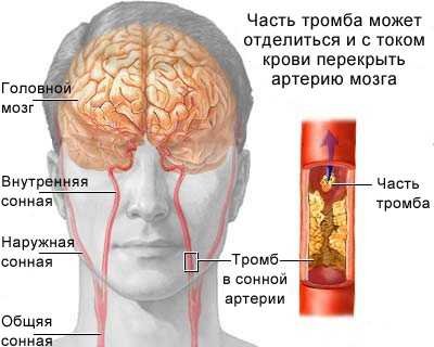 тромб в сонной артерии