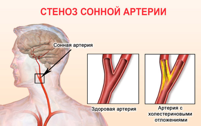 стеноз сонной артерии