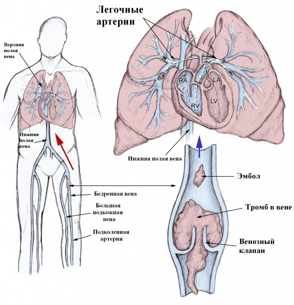 Pulmonary Embolism