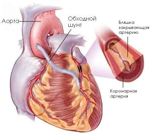 Кардиосклероз