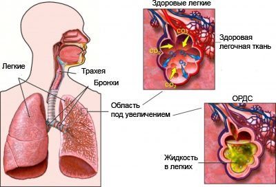 Отек легких