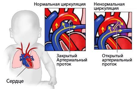 Пороки сердца