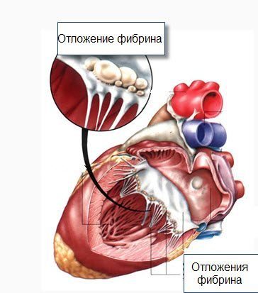 Ревмокардит