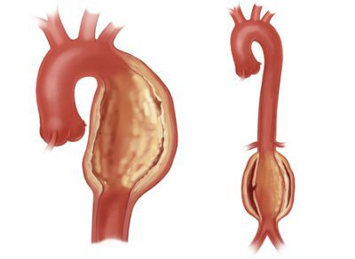 аорта уплотнена что это значит 