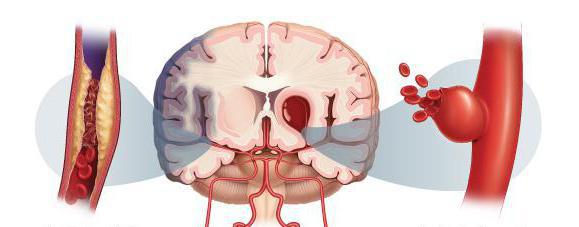 предвестники геморрагического инсульта 