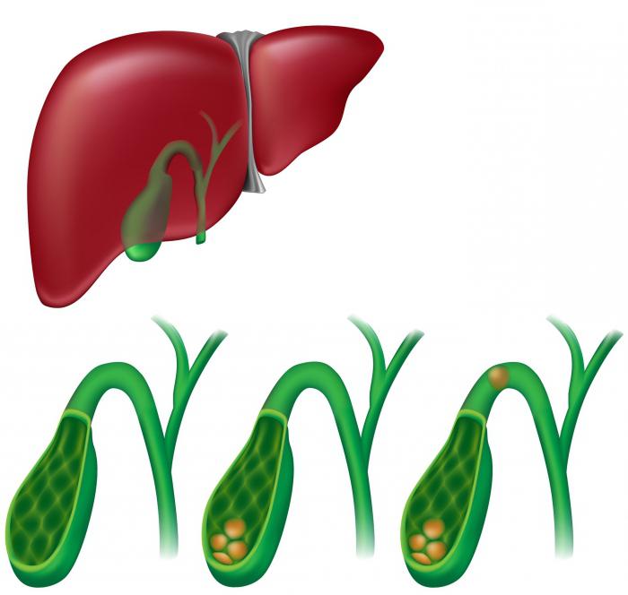 Жизнь после удаления желчного пузыря