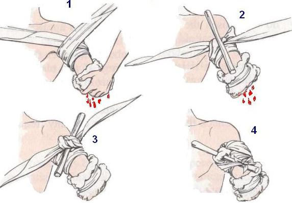 Помощь при артериальном кровотечении