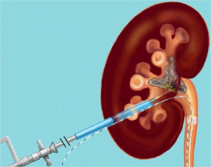 коралловидные камни в почках операция 
