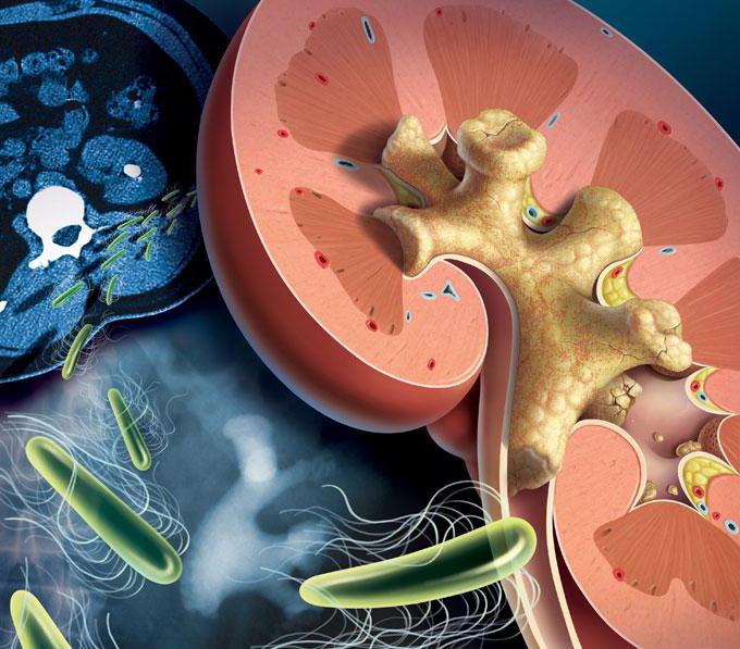 большой коралловидный камень в почке 