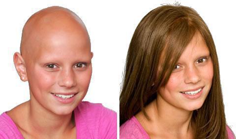 выпадение волос после химиотерапии