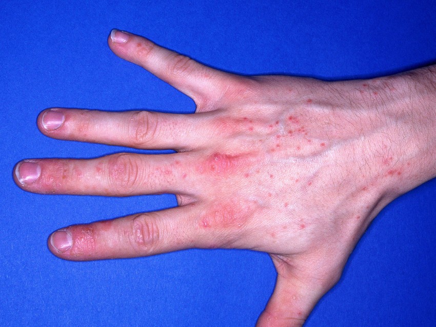 аллергический контактный дерматит