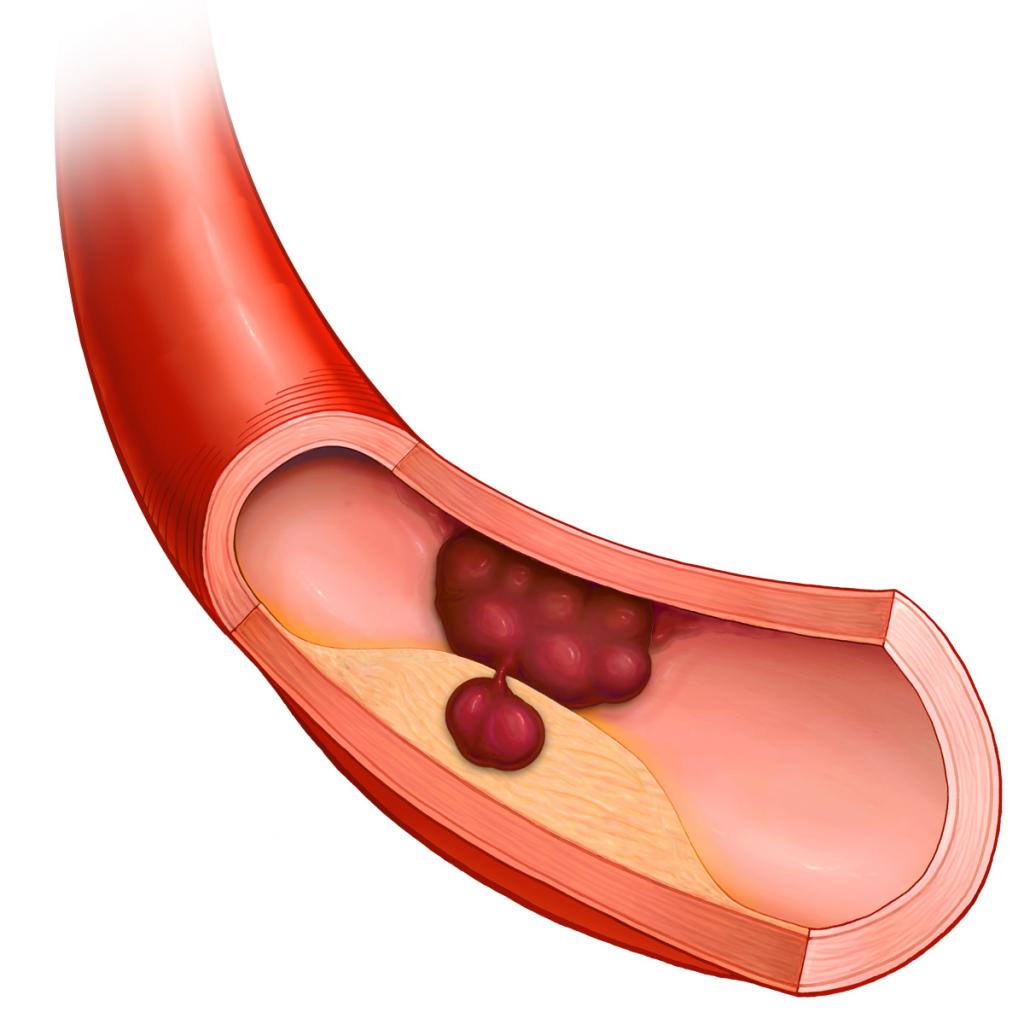 тромб в артерии