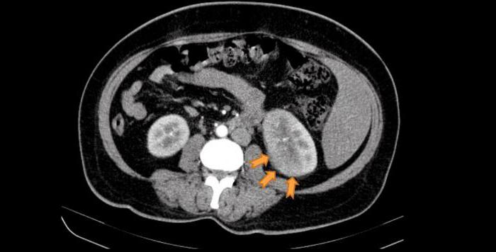 ишемический инфаркт почки