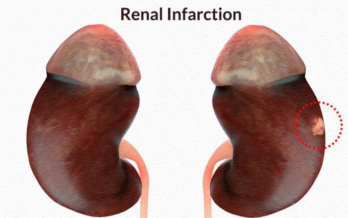 инфаркт почки