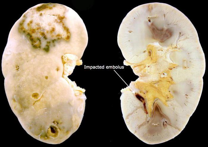 исходы инфаркта почки