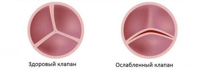 клапан аорты трехстворчатый