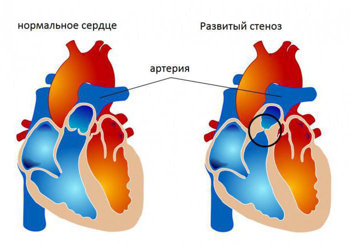 трехстворчатый клапан находится 