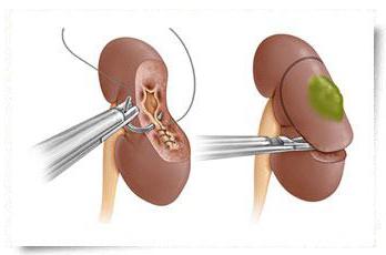 резекция почки отзывы