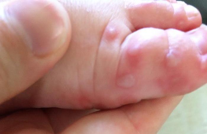 сыпь на ладошках у ребенка и ступнях причины и лечение