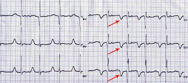 Что показывает ЭКГ