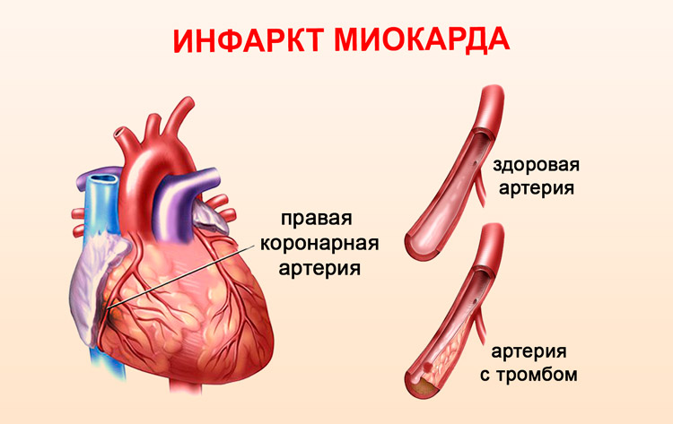 Инфаркт миокарда