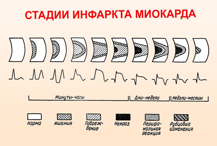 Стадии инфаркта миокарда