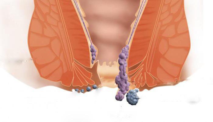 методы оперативного лечения геморроя 