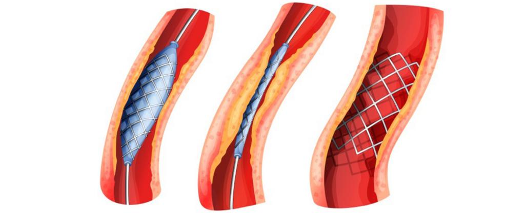 Исследование периферических артерий