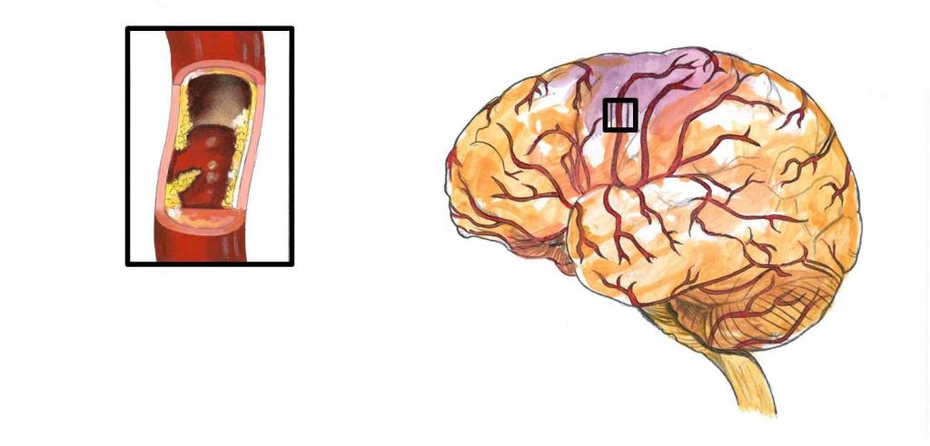 Атеросклероз сосудов головного мозга карта вызова - 88 фото