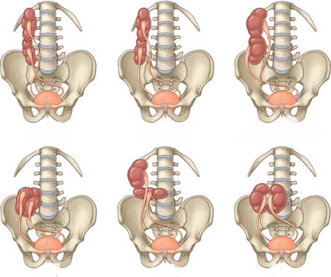 Разновидности ротации почек