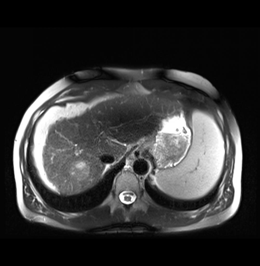 Мрт печени. Магнитно-резонансная томография печени цирроз.