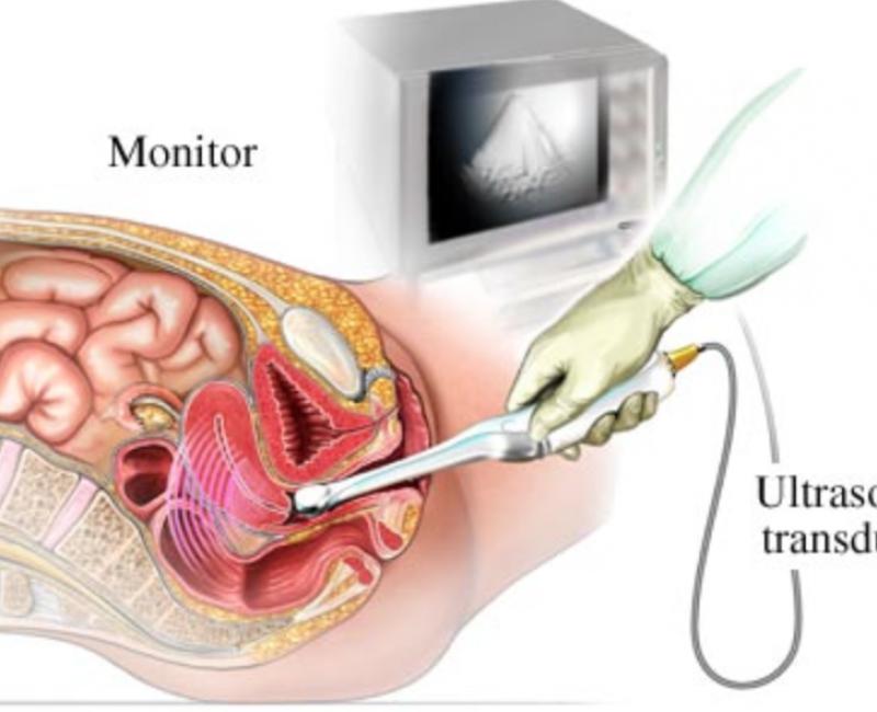 Трансвагинальное УЗИ