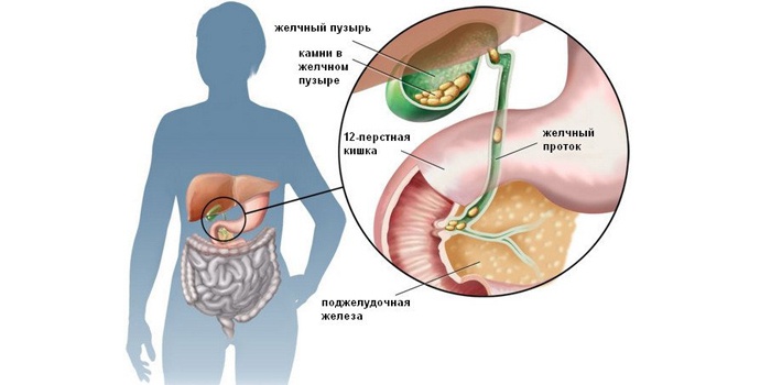 Желчнокаменная болезнь