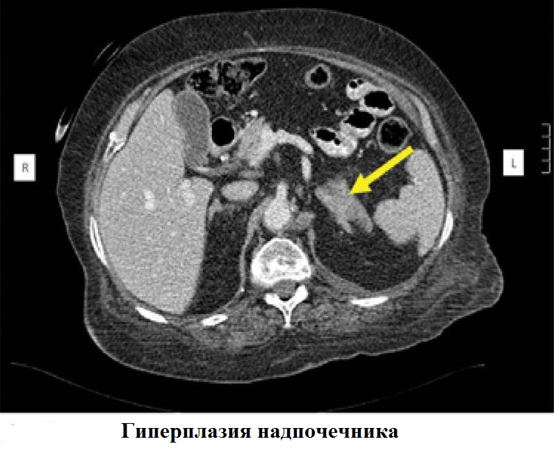 Гиперплазия надпочечника