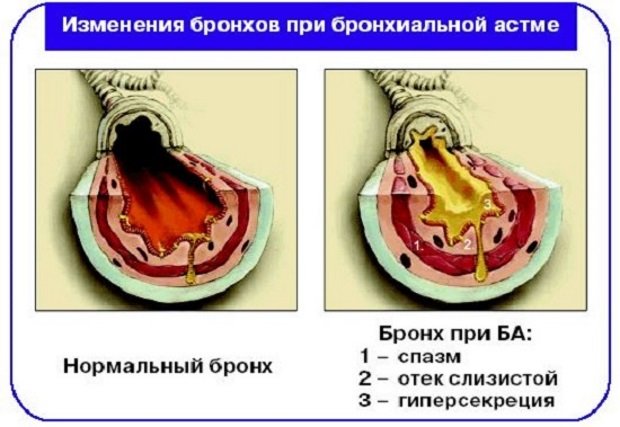 Измененные бронхиальные стенки